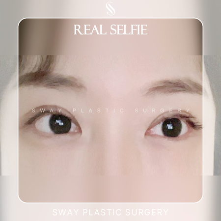 눈성형
